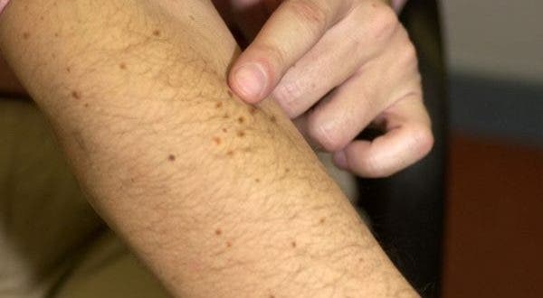 completar Eficiente Taxi Herpes zóster, un virus dormido que puede despertar con la vacuna de la covid - MICOF - Muy Ilustre Colegio Oficial de Farmacéuticos de Valencia completar Eficiente Taxi Herpes zóster, un virus dormido que puede despertar con la vacuna de la covid - MICOF - Muy Ilustre Colegio Oficial de Farmacéuticos de Valencia