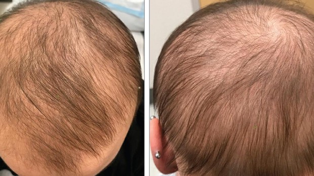 Un fármaco para la dermatitis atópica hace crecer el pelo en un caso alopecia MICOF - Muy Ilustre Colegio Oficial de Farmacéuticos de Valencia